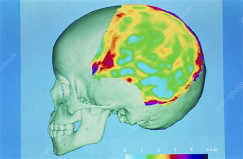 measuring skull thickness|average human skull thickness.